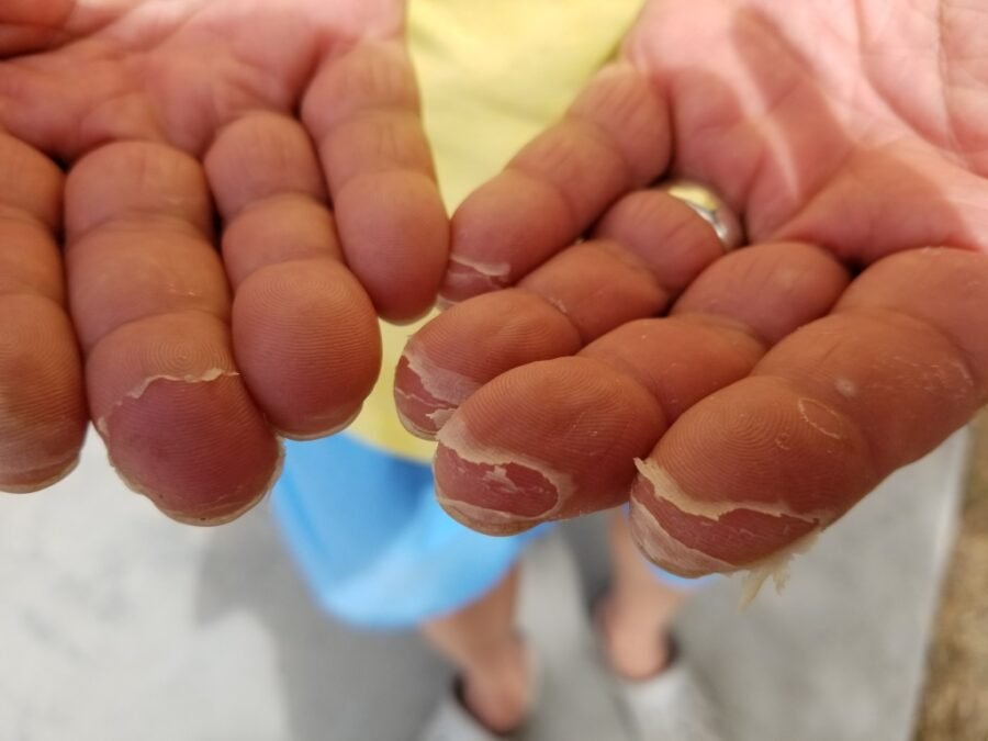 Hands Peeling From Salt Water and Fishing